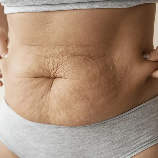 Cellulite and loose skin on the stomach